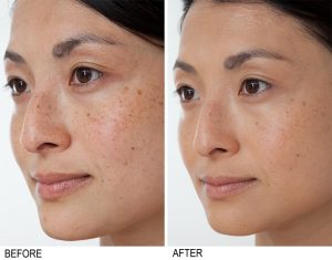 neutrogena dark spot corrector before and after