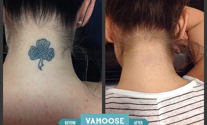 tattoo-removal-before-after-neck-vamoose@2x-680×455